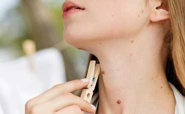 Как ухаживать за родинками и какие из них опасны: важные советы дерматолога