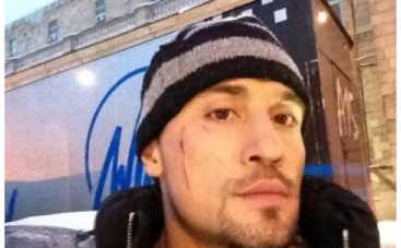 Диме Билана расцарапали лицо