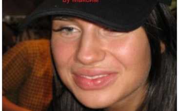 Певица Алекса уже 5 лет мучается из-за пластики