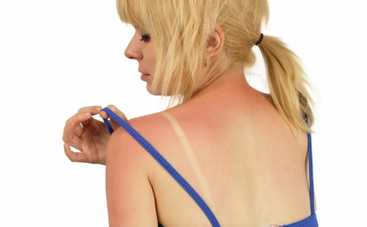 Отпуск 2014: аптечные и народные средства от неудачного загара